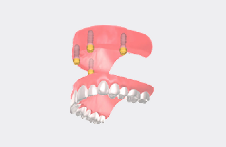 ロケーター義歯