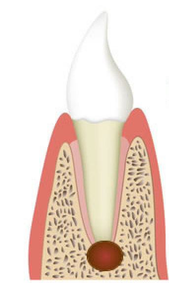 歯根の先に感染が見られる